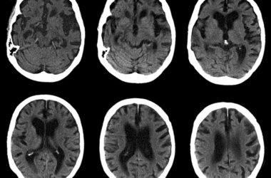 Cerebro con enfermedad de Alzheimer, tomografía computarizada