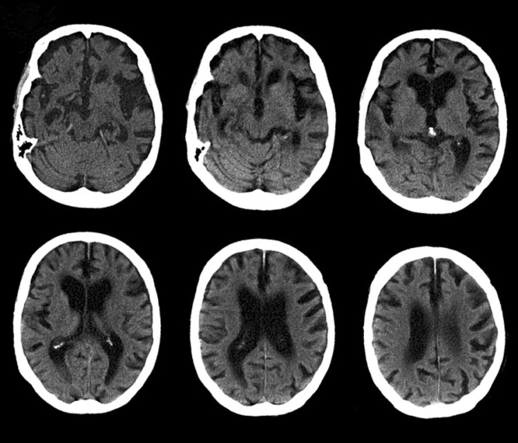 Cerebro con enfermedad de Alzheimer, tomografía computarizada