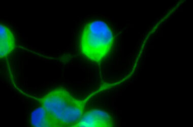 Neurona de paciente MELAS obtenida por reprogramación directa y cocultivada con astrocitos.