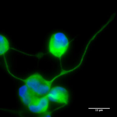 Neurona de paciente MELAS obtenida por reprogramación directa y cocultivada con astrocitos.