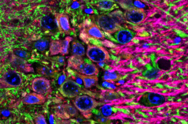 Neuronas del hipocampo que regulan la memoria y afectadas por la patología en el ratón con la enfermedad de Alzheimer generado en el estudio. ©UAB