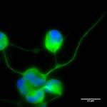 Neurona paciente MELAS